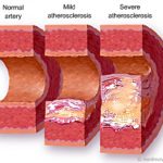 Compare your Cholesterol Levels, the good and the bad