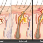 How To: Diagnosing and Treating Boils