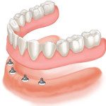 A Dentist Can Implant Dentures as an Implant Tooth