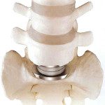 Spine Surgery – Total Disc Replacement or Spinal Fusion
