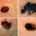 Are Moles Skin Cancer or Melanoma – What is a Mole