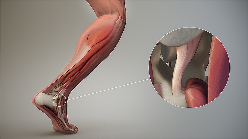 What is a Tendon Rupture or Torn Tendon?