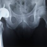 Adequate post hip surgery precautions