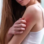 Hives causes, hives rash, hives treatment, hives on skin