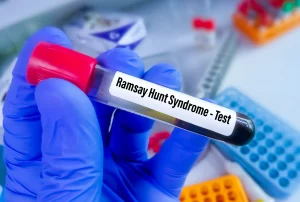ramsay hunt disease, ramsay hunt syndrome symptoms